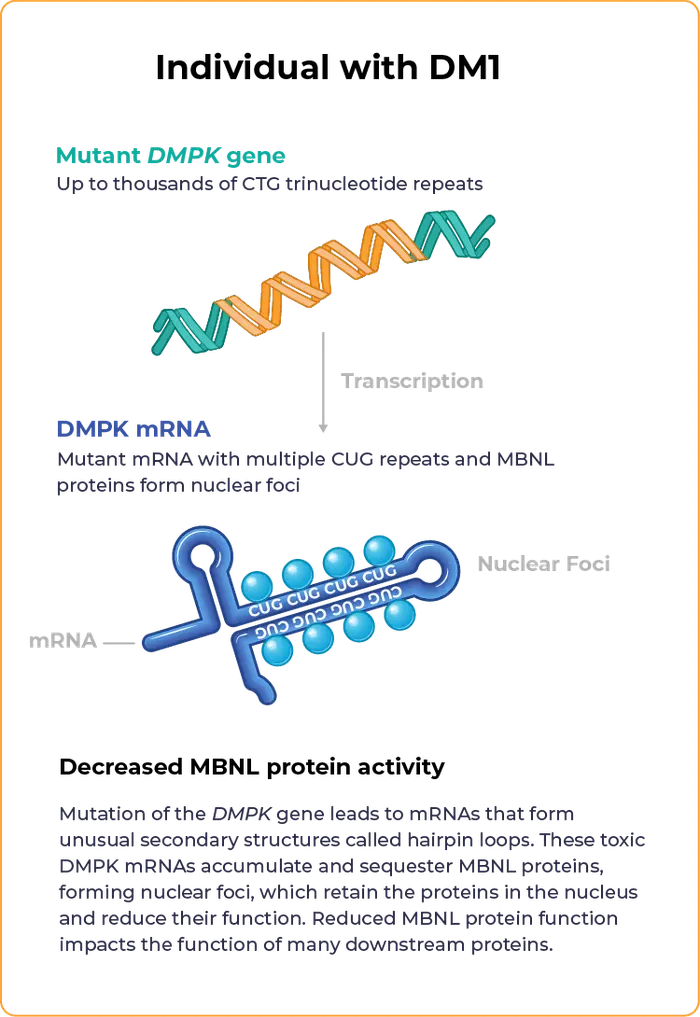 Graphic depicting an individual with DM1 and decreased MBNL protein activity